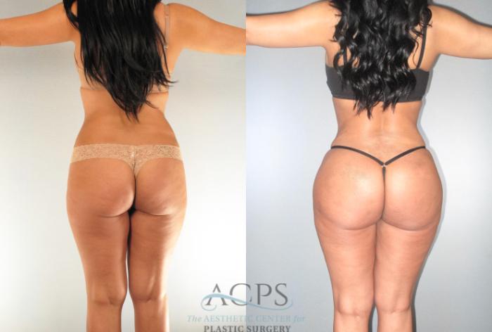 Before & After Brazilian Butt Lift (BBL) Case 486 Rear View: View in Houston, TX