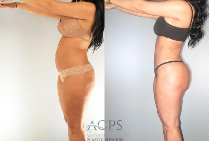 Before & After Brazilian Butt Lift (BBL) Case 486 Side View: View in Houston, TX