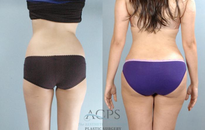 Before & After Brazilian Butt Lift (BBL) Case 487 Rear View: View in Houston, TX