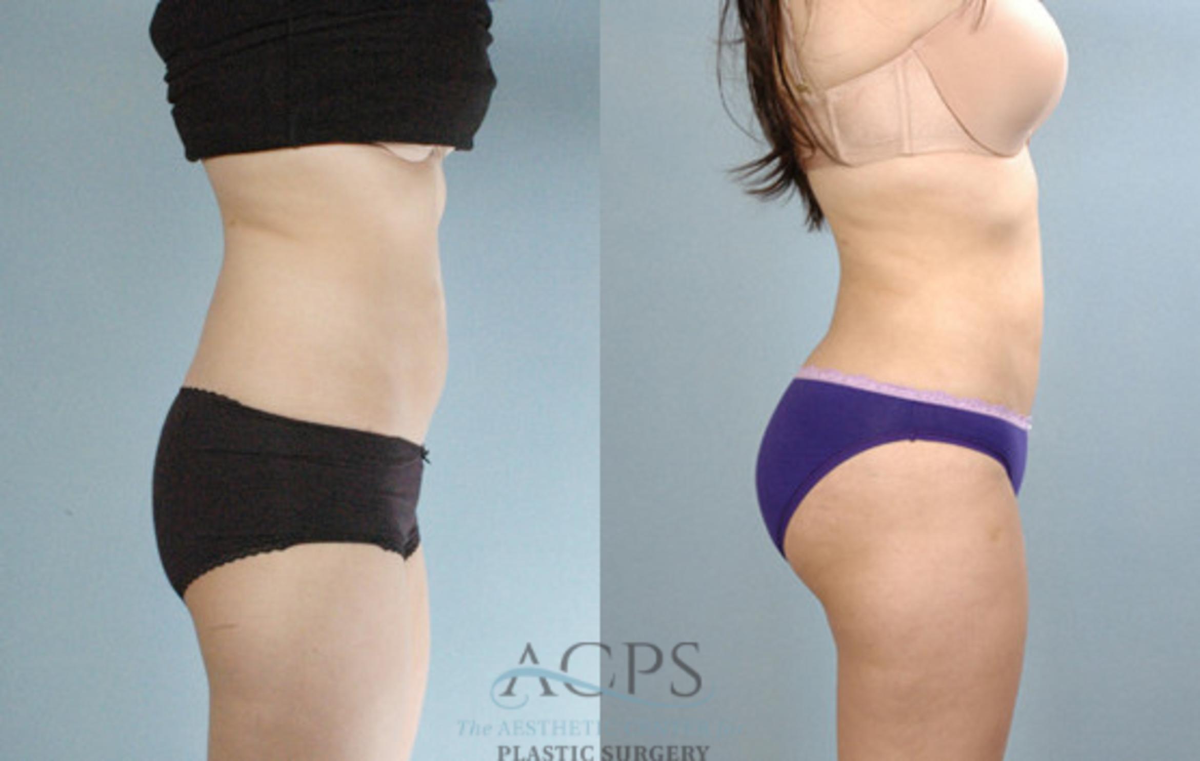 Before & After Brazilian Butt Lift (BBL) Case 487 Side View: View in Houston, TX