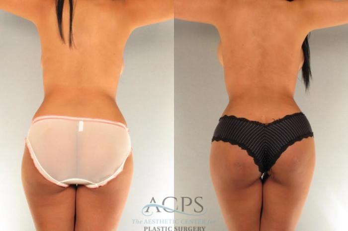 Before & After Brazilian Butt Lift (BBL) Case 493 Rear View: View in Houston, TX