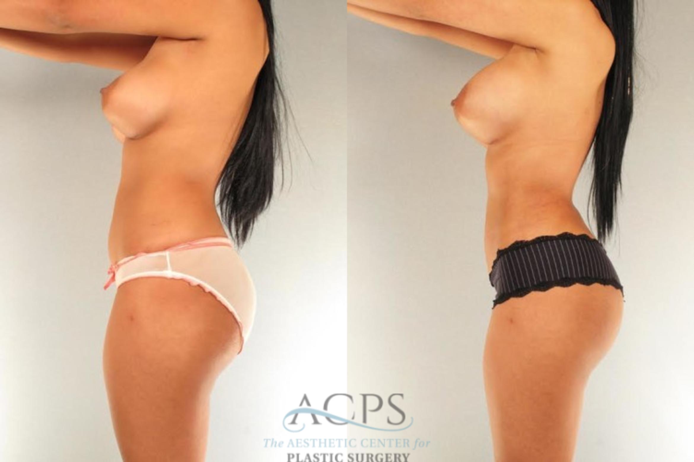 Before & After Brazilian Butt Lift (BBL) Case 493 Side View: View in Houston, TX