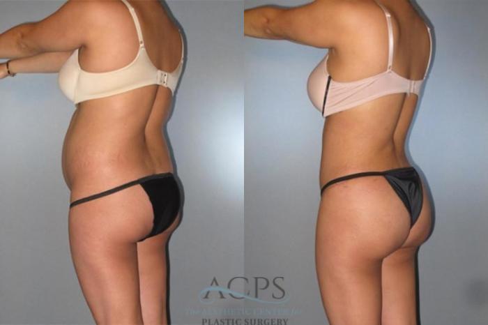 Before & After Brazilian Butt Lift (BBL) Case 494 Oblique View: View in Houston, TX