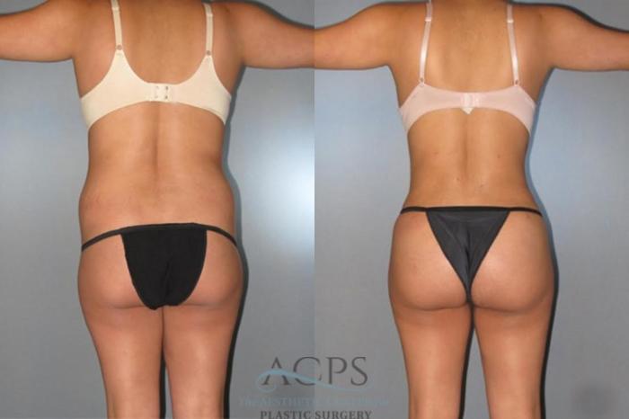 Before & After Brazilian Butt Lift (BBL) Case 494 Rear View: View in Houston, TX