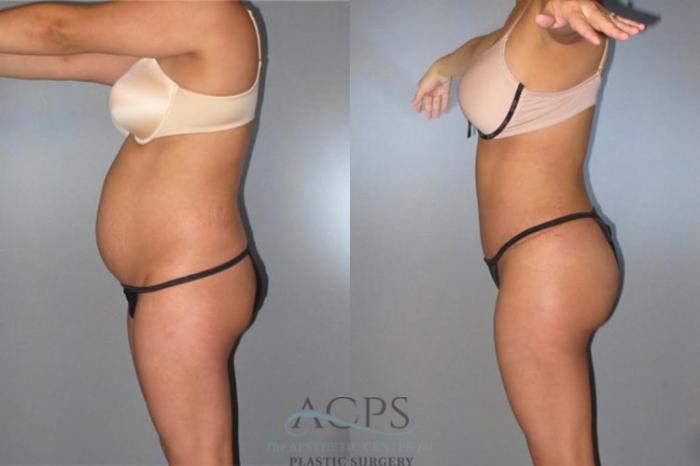 Before & After Brazilian Butt Lift (BBL) Case 494 Side View: View in Houston, TX