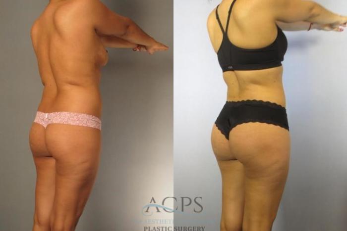 Before & After Brazilian Butt Lift (BBL) Case 495 Oblique View: View in Houston, TX