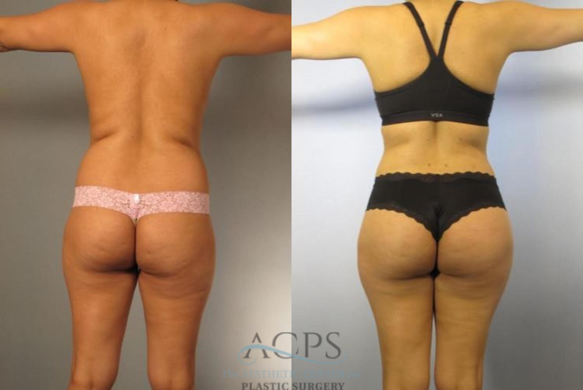 Before & After Brazilian Butt Lift (BBL) Case 495 Rear View: View in Houston, TX