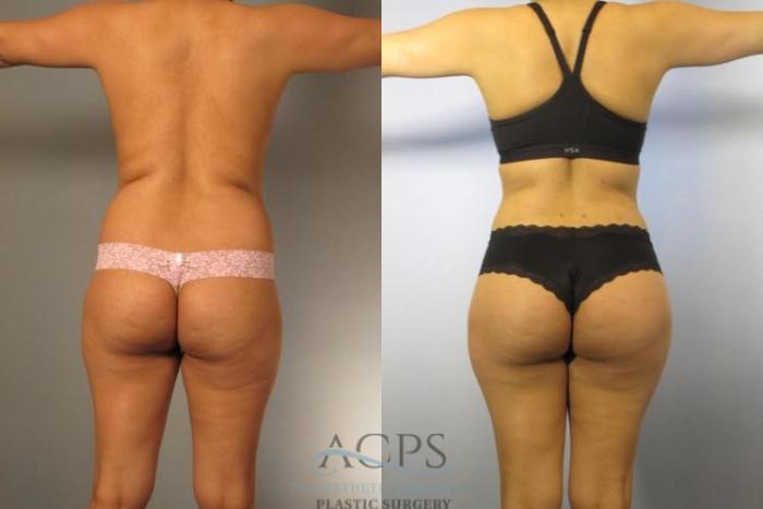 Before & After Brazilian Butt Lift (BBL) Case 495 Rear View: View in Houston, TX