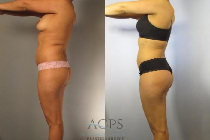 Before & After Brazilian Butt Lift (BBL) Case 495 Side View: View in Houston, TX