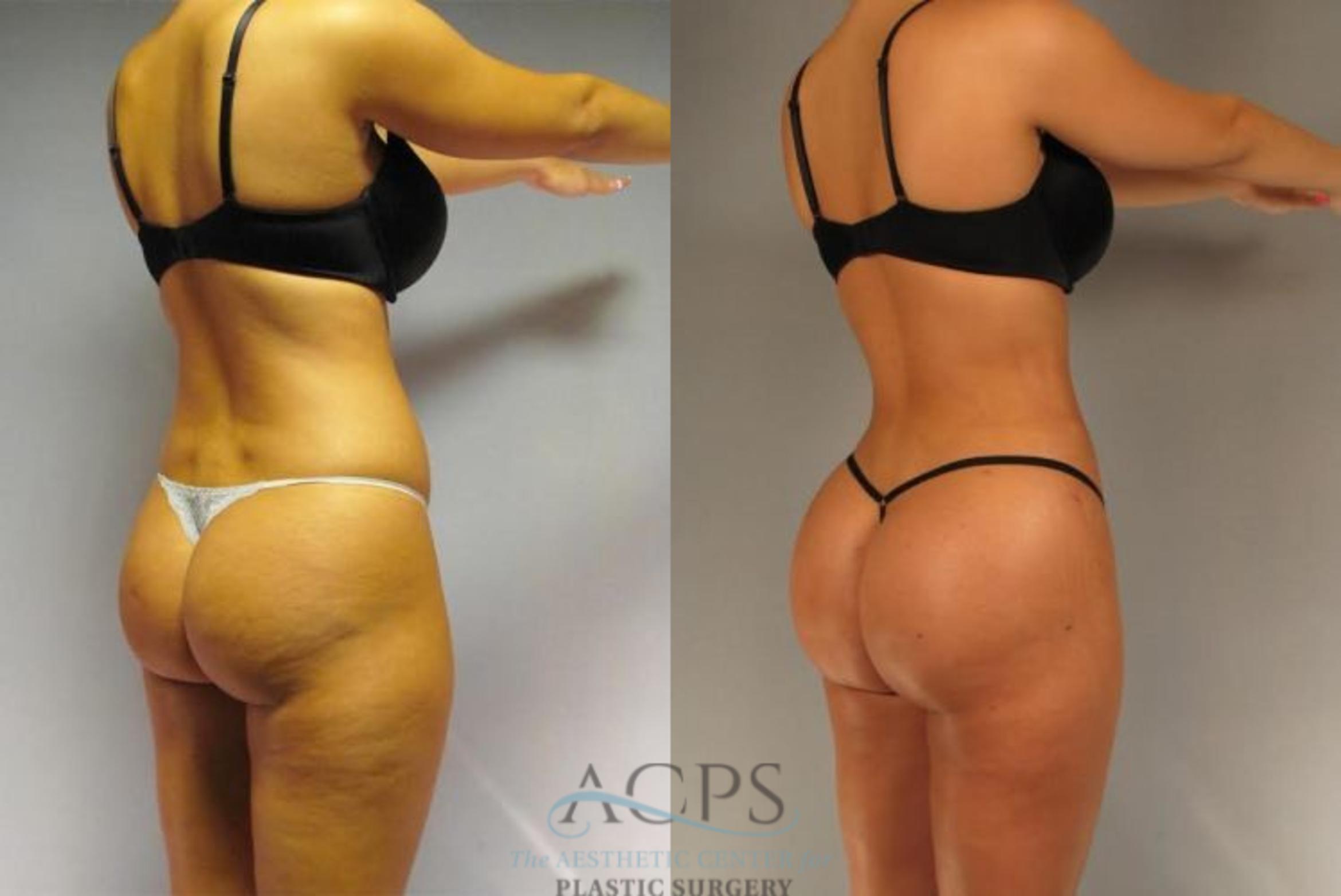 Before & After Brazilian Butt Lift (BBL) Case 496 Oblique View: View in Houston, TX