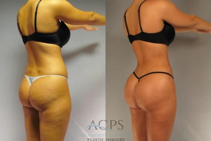 Before & After Brazilian Butt Lift (BBL) Case 496 Oblique View: View in Houston, TX