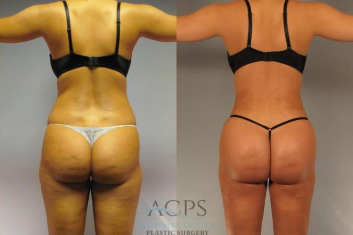 Before & After Brazilian Butt Lift (BBL) Case 496 Rear View: View in Houston, TX