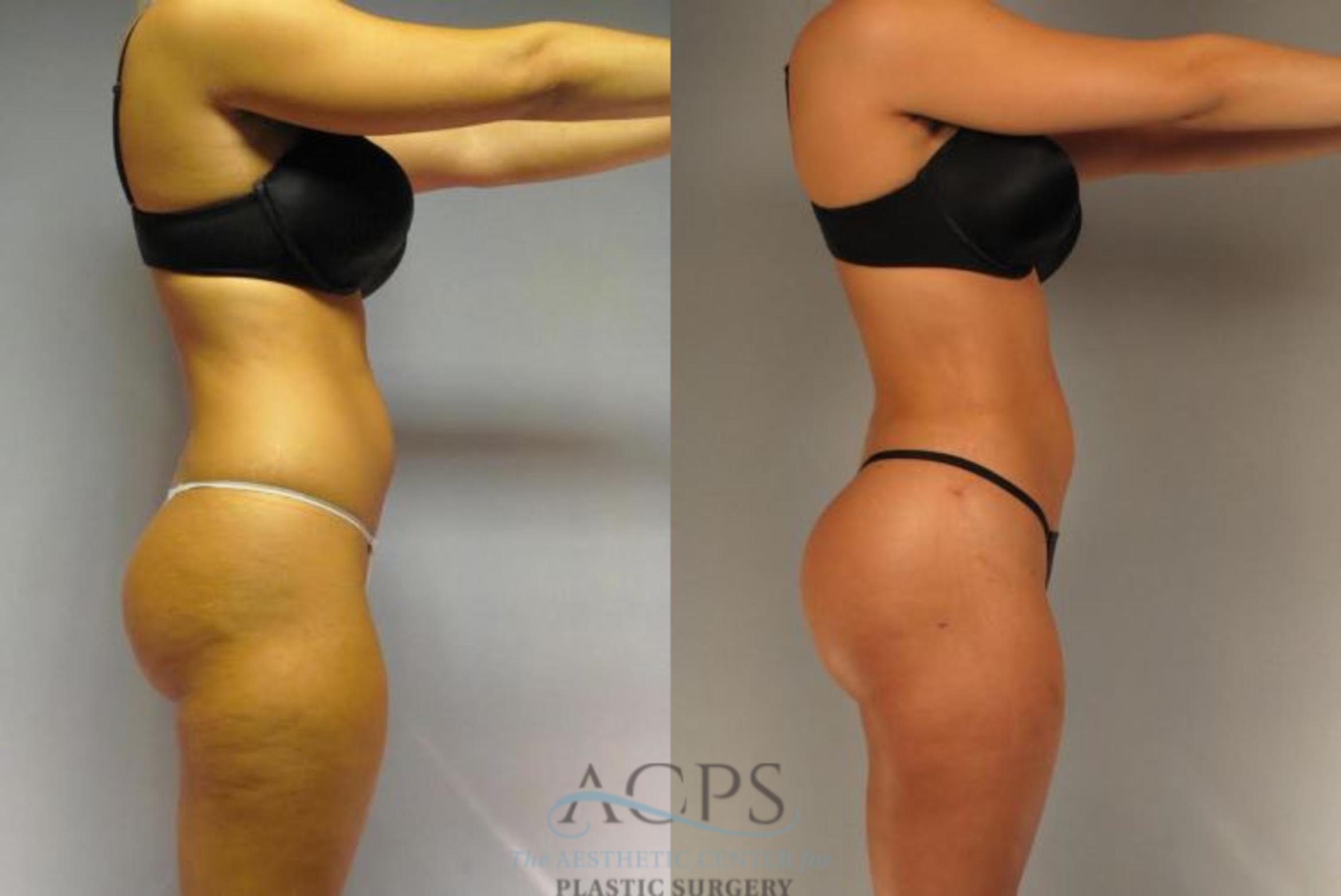 Before & After Brazilian Butt Lift (BBL) Case 496 Side View: View in Houston, TX