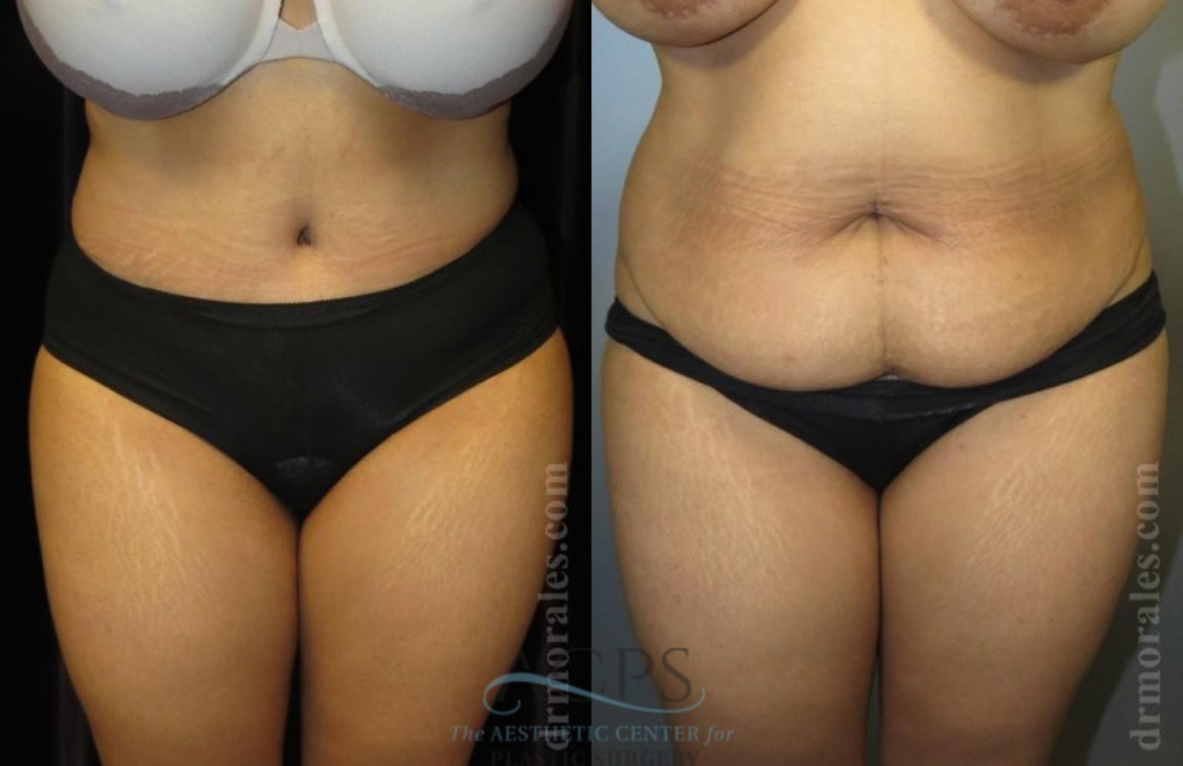 Before & After Brazilian Butt Lift (BBL) Case 497 Front View: View in Houston, TX