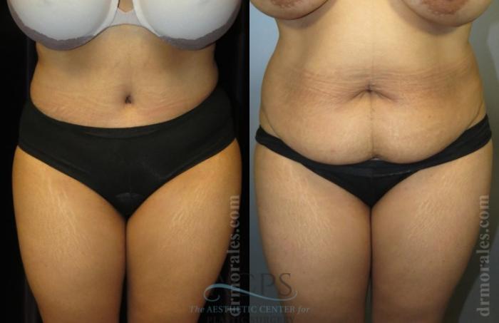 Before & After Brazilian Butt Lift (BBL) Case 497 Front View: View in Houston, TX