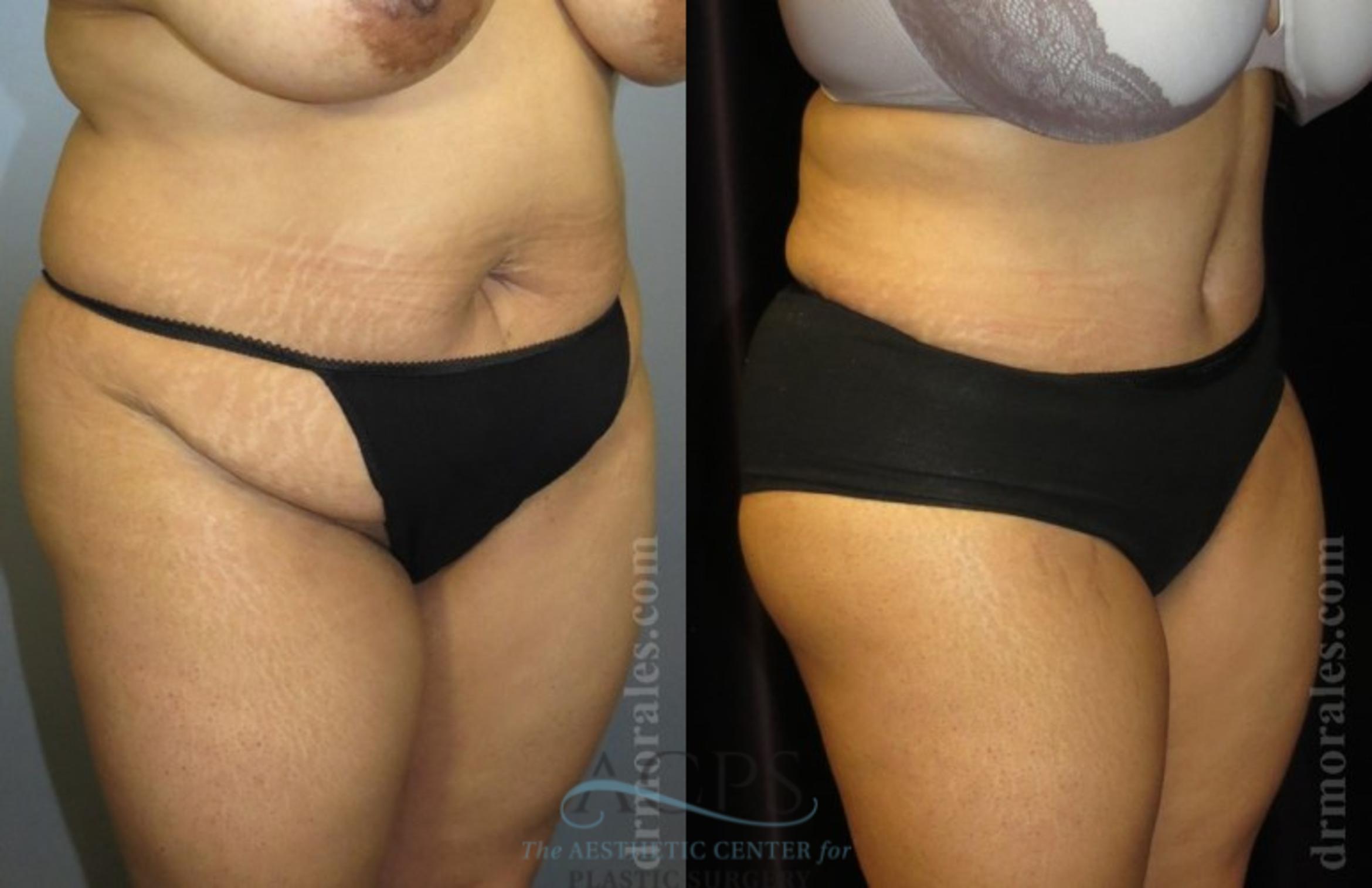 Before & After Brazilian Butt Lift (BBL) Case 497 Oblique View: View in Houston, TX