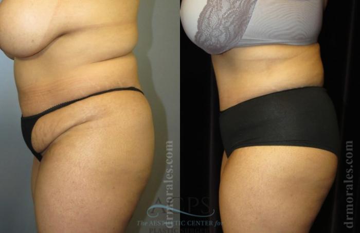 Before & After Brazilian Butt Lift (BBL) Case 497 Side View: View in Houston, TX