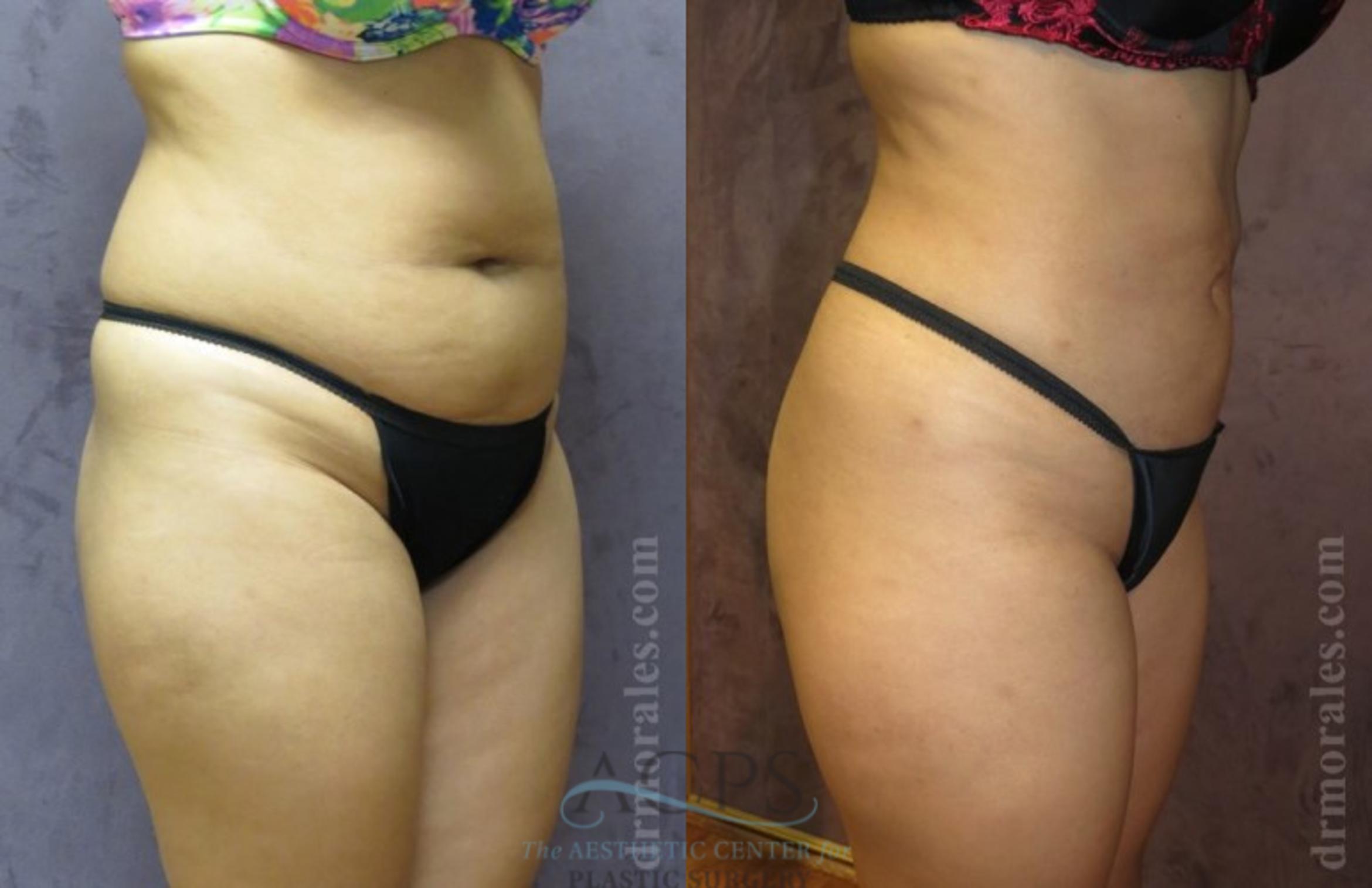 Before & After Brazilian Butt Lift (BBL) Case 498 Oblique View: View in Houston, TX