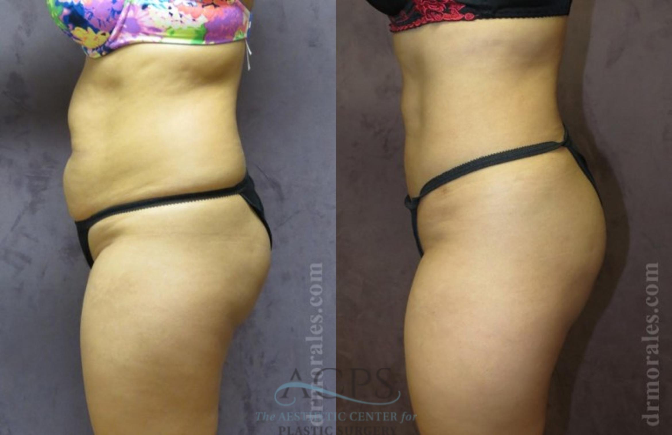 Before & After Brazilian Butt Lift (BBL) Case 498 Side View: View in Houston, TX