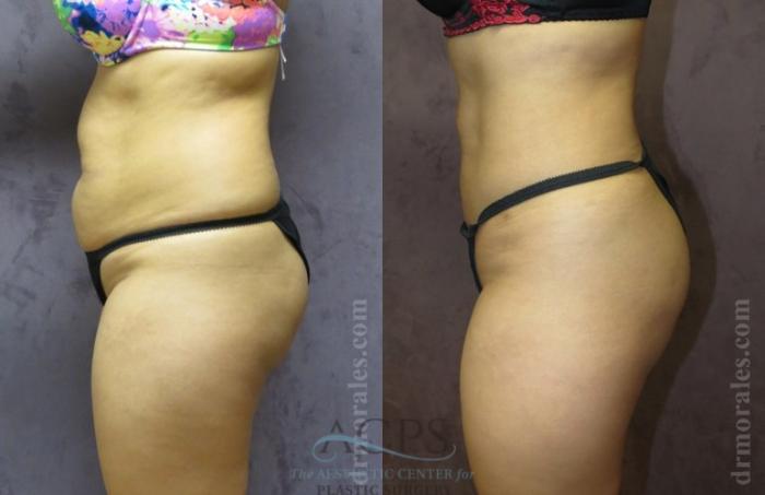 Before & After Brazilian Butt Lift (BBL) Case 498 Side View: View in Houston, TX