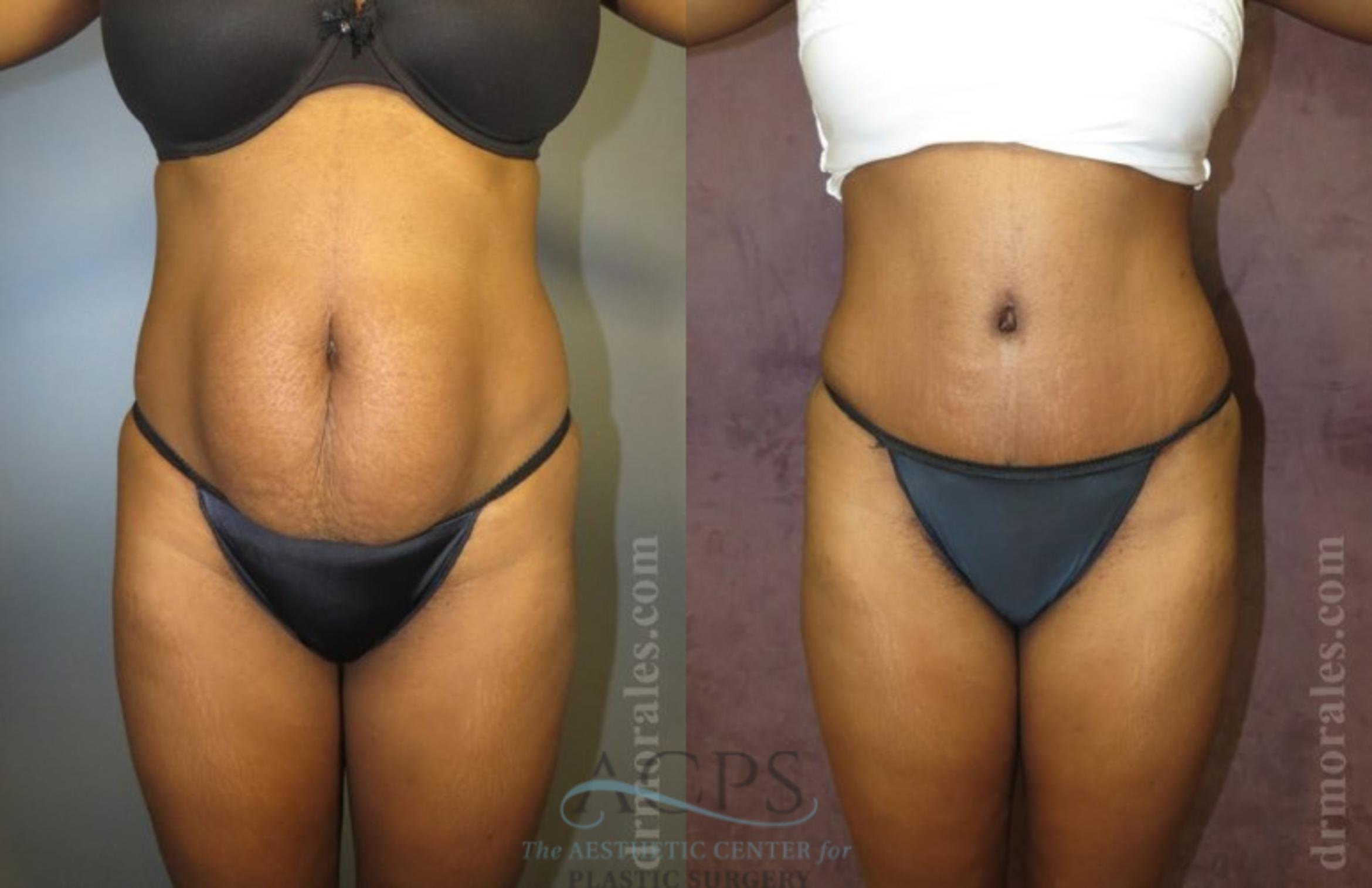 Before & After Brazilian Butt Lift (BBL) Case 499 Front View: View in Houston, TX