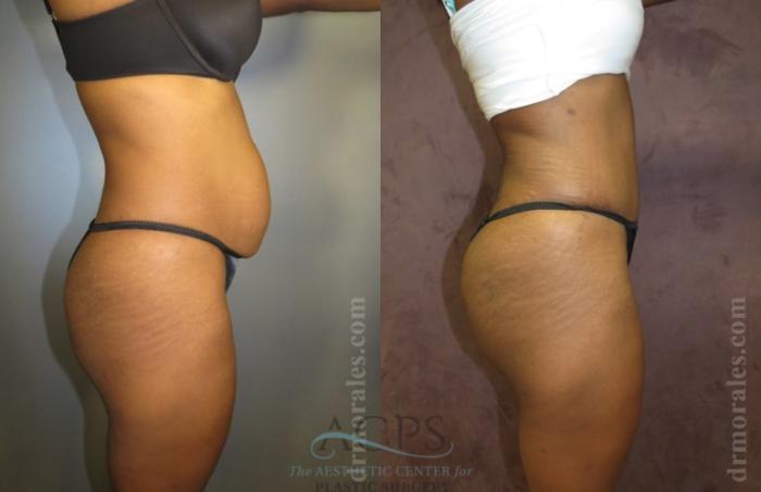 Before & After Brazilian Butt Lift (BBL) Case 499 Side View: View in Houston, TX
