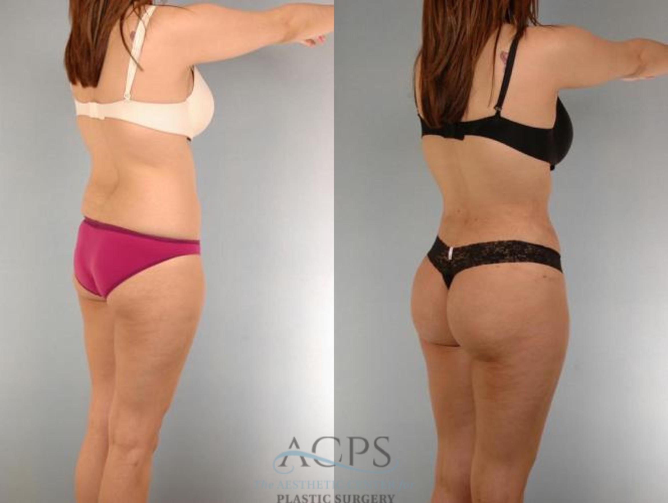 Before & After Brazilian Butt Lift (BBL) Case 501 Rear View: View in Houston, TX