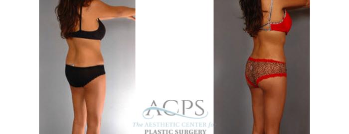 Before & After Brazilian Butt Lift (BBL) Case 502 Oblique View: View in Houston, TX