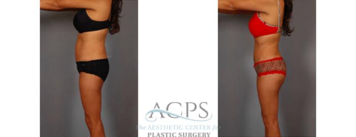 Before & After Brazilian Butt Lift (BBL) Case 502 Side View: View in Houston, TX