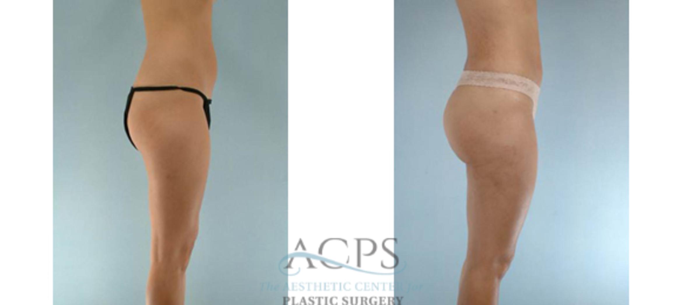 Before & After Brazilian Butt Lift (BBL) Case 503 Side View: View in Houston, TX