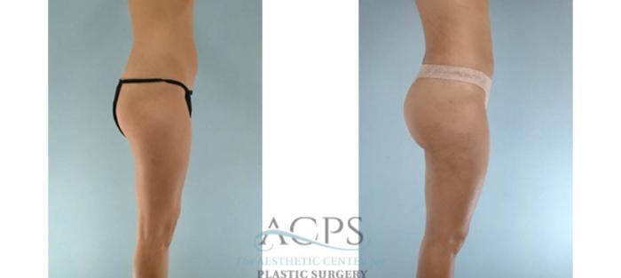 Before & After Brazilian Butt Lift (BBL) Case 503 Side View: View in Houston, TX