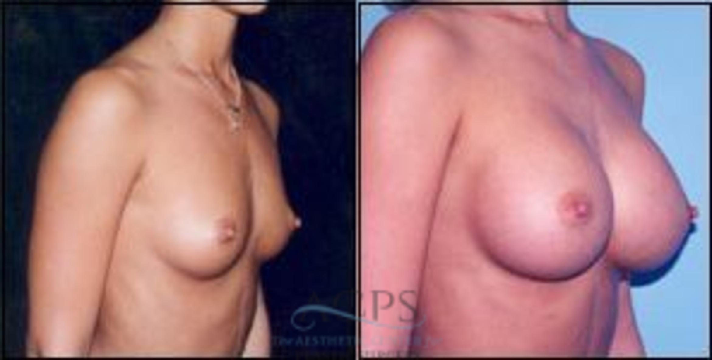 Before & After Breast Augmentation Case 1011 Oblique View: View in Houston, TX