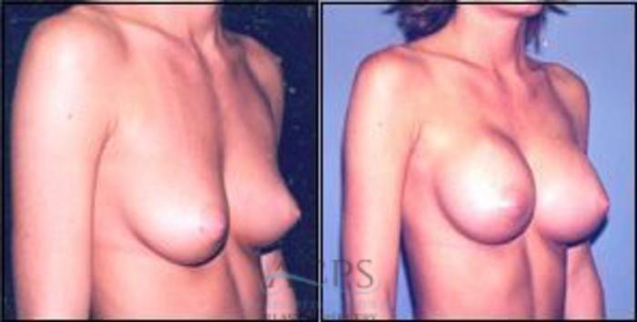 Before & After Breast Augmentation Case 1012 Oblique View: View in Houston, TX