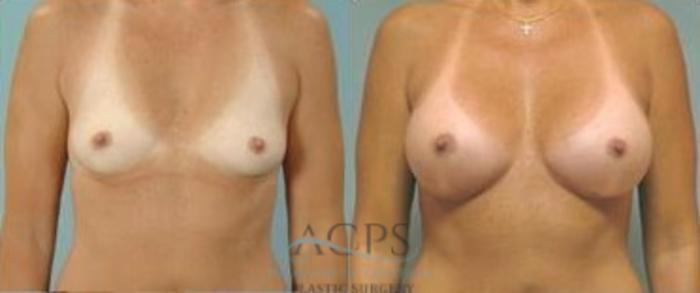Before & After Breast Augmentation Case 1013 Front View: View in Houston, TX