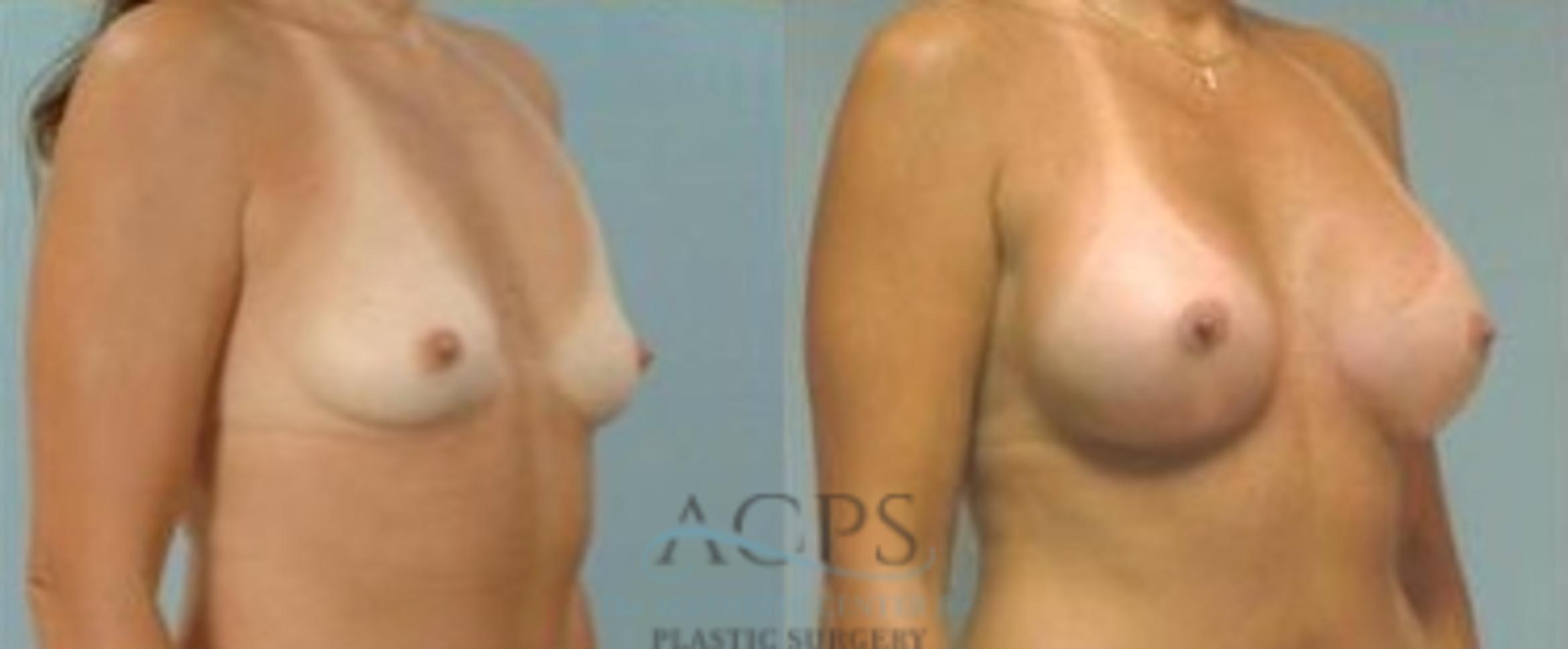 Before & After Breast Augmentation Case 1013 Oblique View: View in Houston, TX