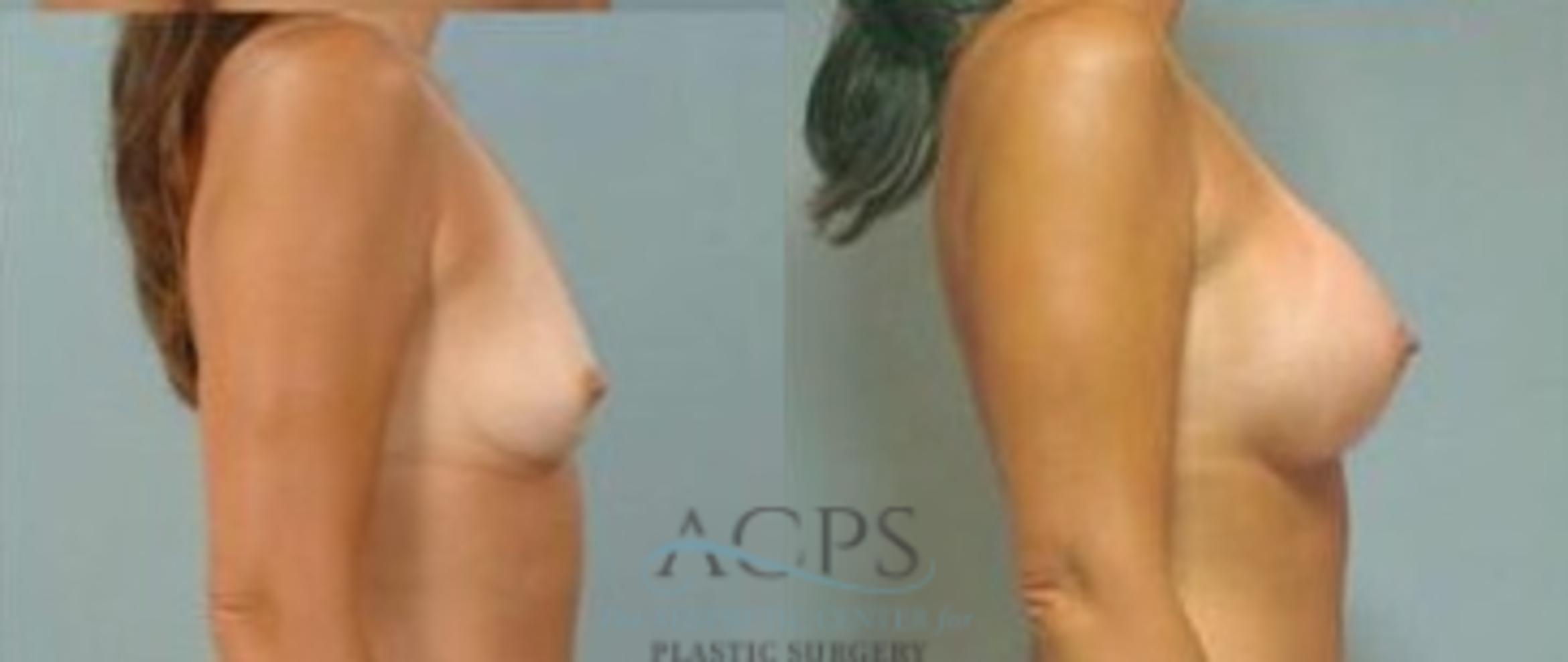 Before & After Breast Augmentation Case 1013 Side View: View in Houston, TX