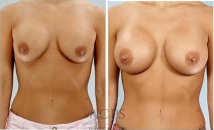 Before & After Breast Augmentation Case 1014 Front View: View in Houston, TX