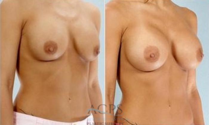 Before & After Breast Augmentation Case 1014 Oblique View: View in Houston, TX
