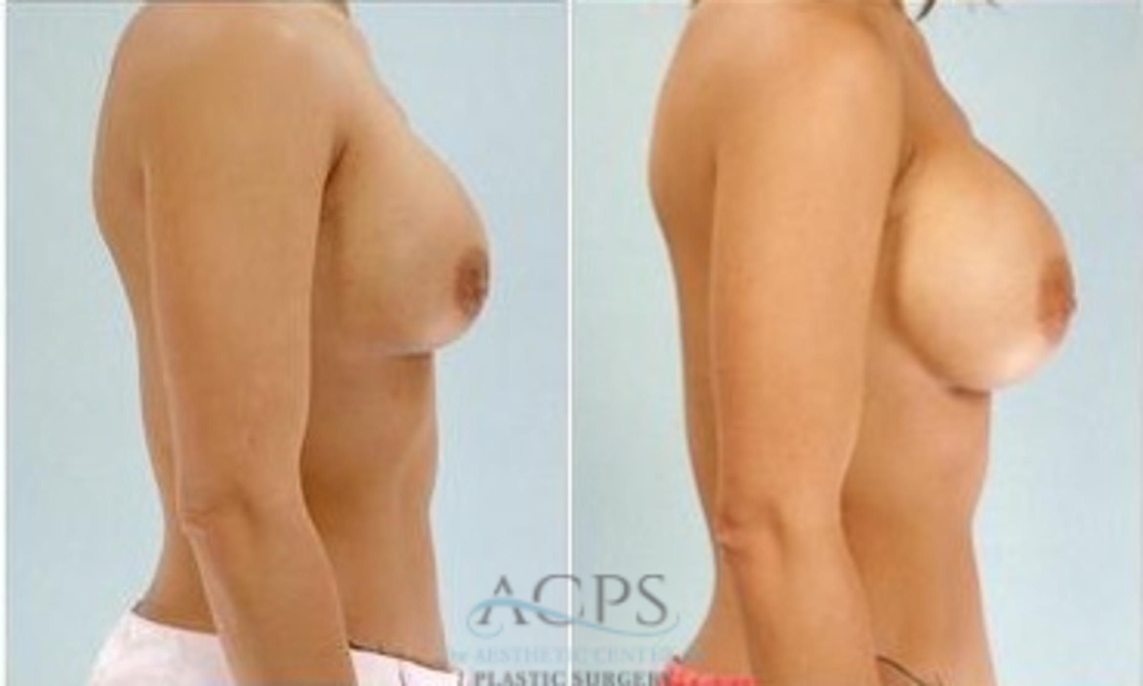 Before & After Breast Augmentation Case 1014 Side View: View in Houston, TX