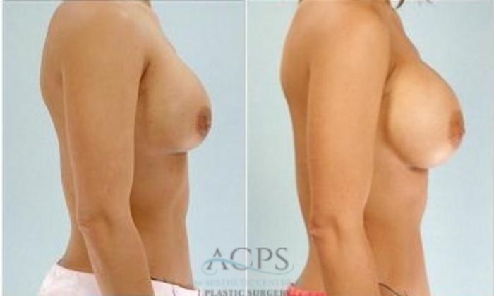 Before & After Breast Augmentation Case 1014 Side View: View in Houston, TX