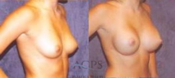 Before & After Breast Augmentation Case 1015 Oblique View: View in Houston, TX