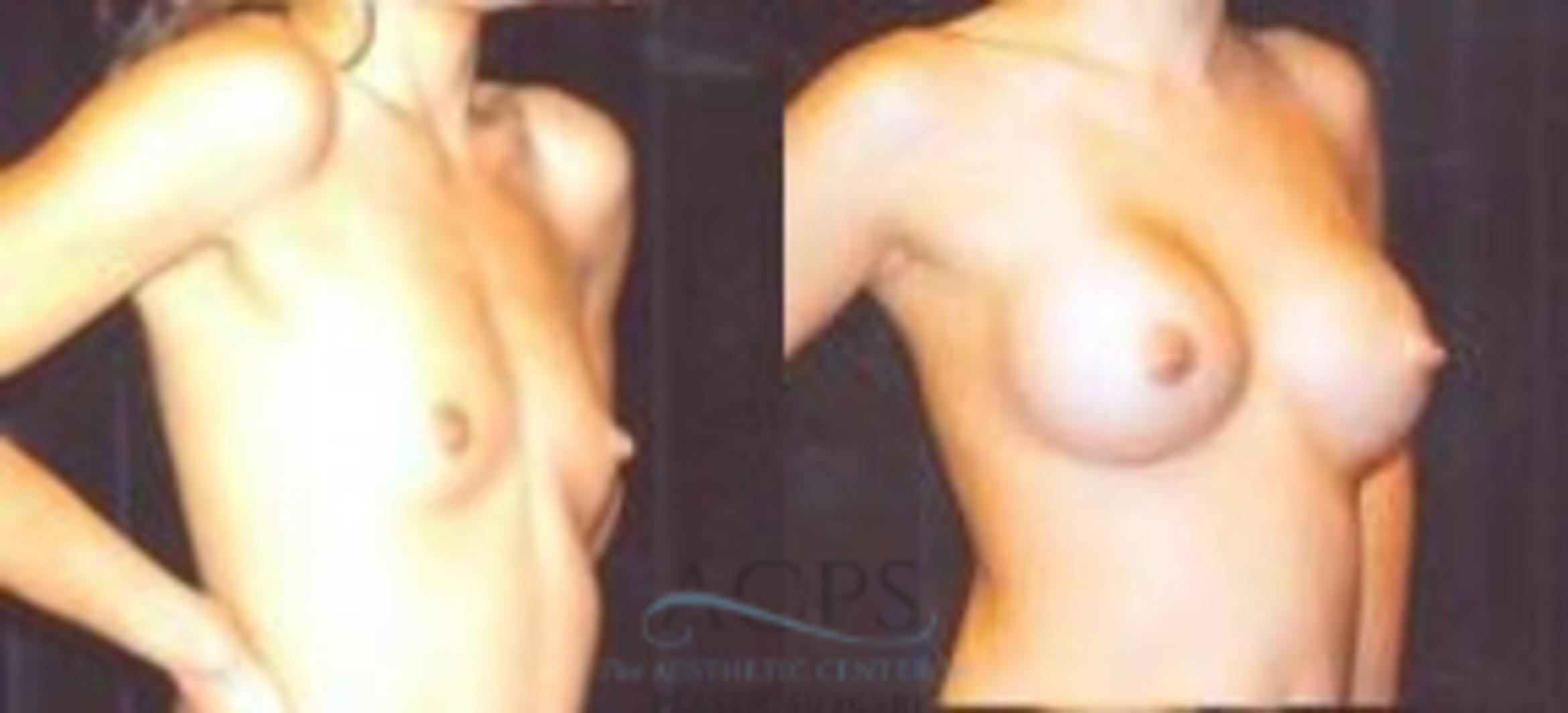 Before & After Breast Augmentation Case 1016 Oblique View: View in Houston, TX