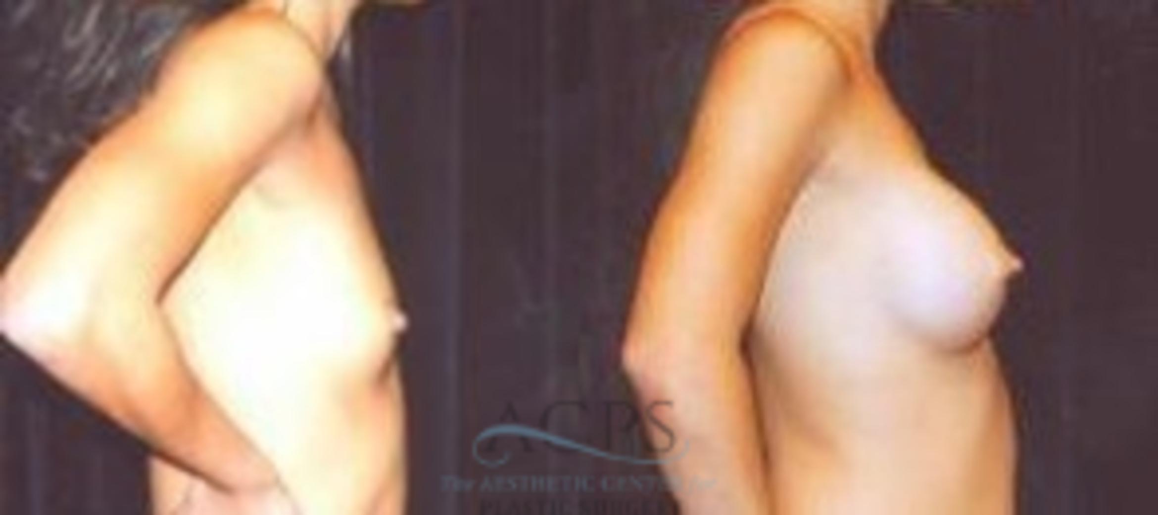Before & After Breast Augmentation Case 1016 Side View: View in Houston, TX