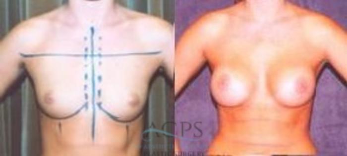 Before & After Breast Augmentation Case 1017 Front View: View in Houston, TX
