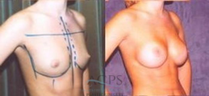 Before & After Breast Augmentation Case 1017 Oblique View: View in Houston, TX