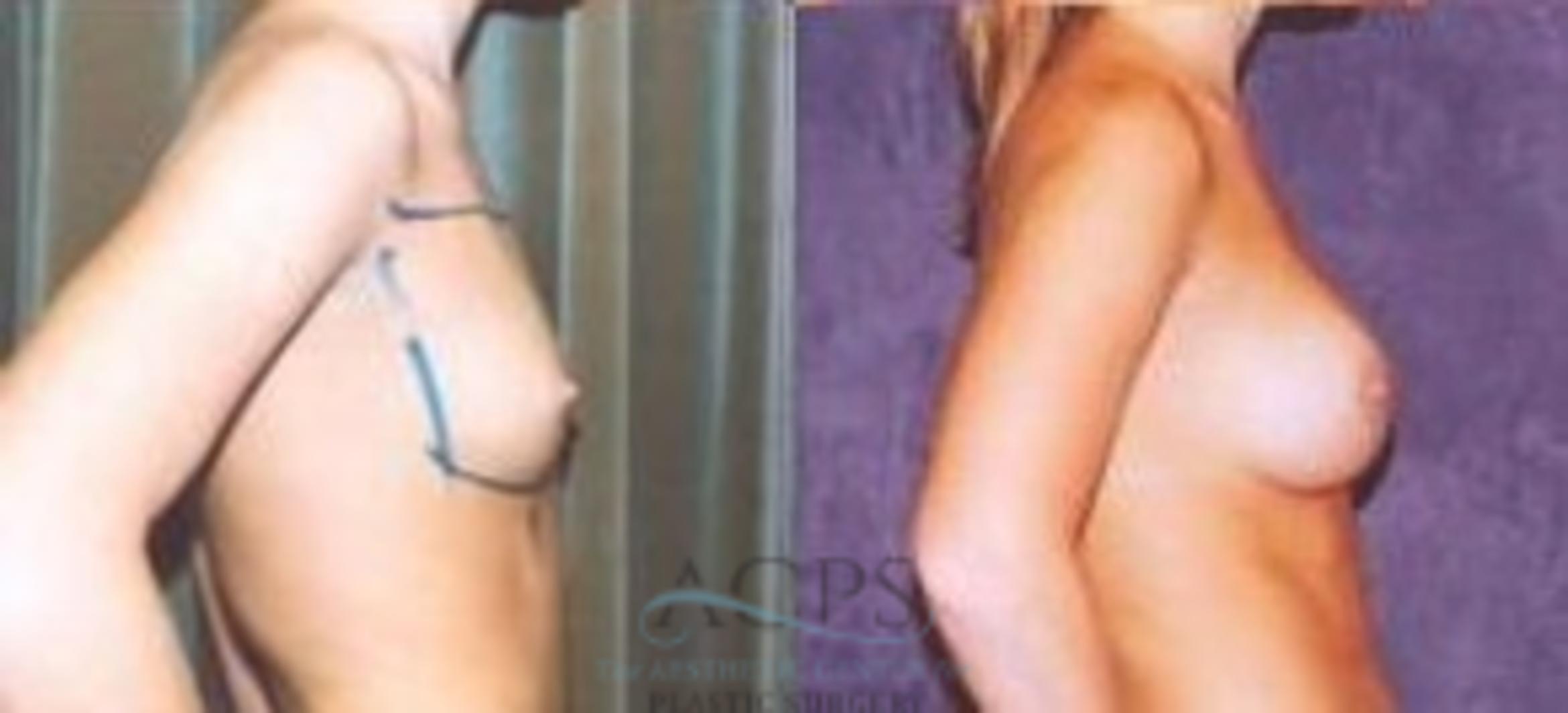 Before & After Breast Augmentation Case 1017 Side View: View in Houston, TX