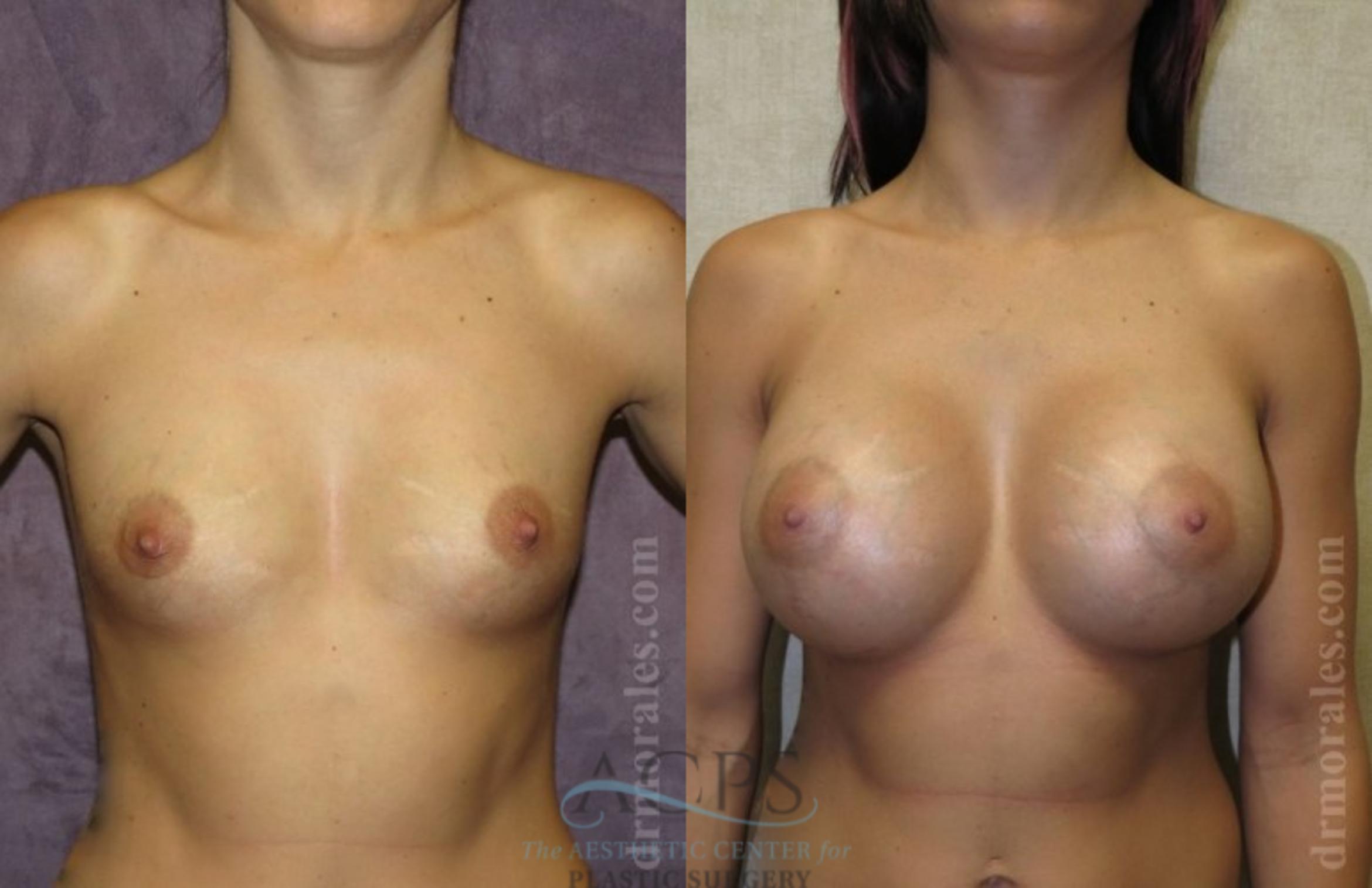 Before & After Breast Augmentation Case 1018 Front View: View in Houston, TX