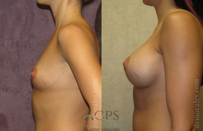 Before & After Breast Augmentation Case 1018 Side View: View in Houston, TX