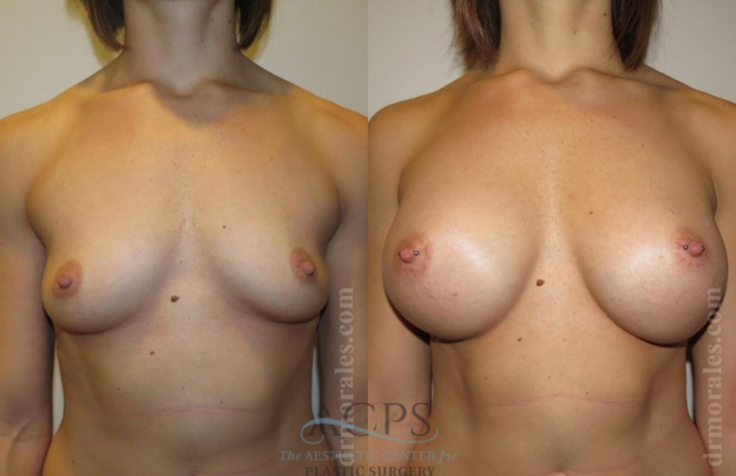 Before & After Breast Augmentation Case 1019 Front View: View in Houston, TX