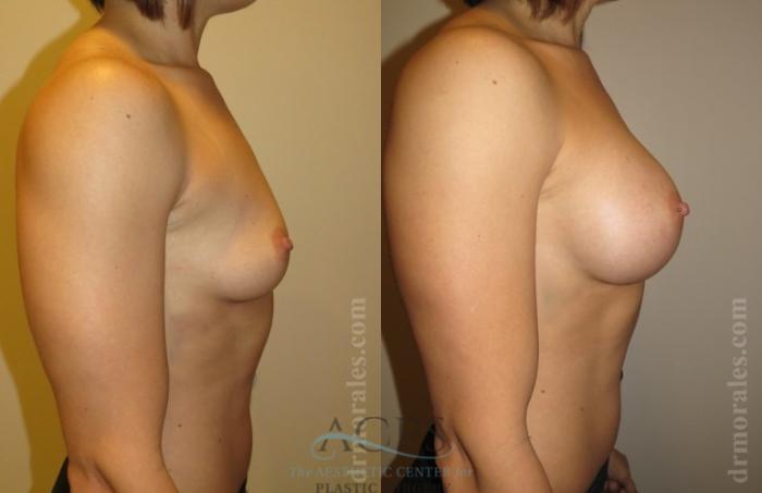 Before & After Breast Augmentation Case 1019 Side View: View in Houston, TX